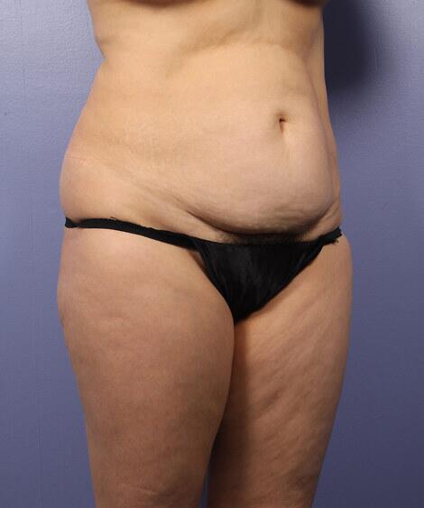 Liposuction Before & After Image