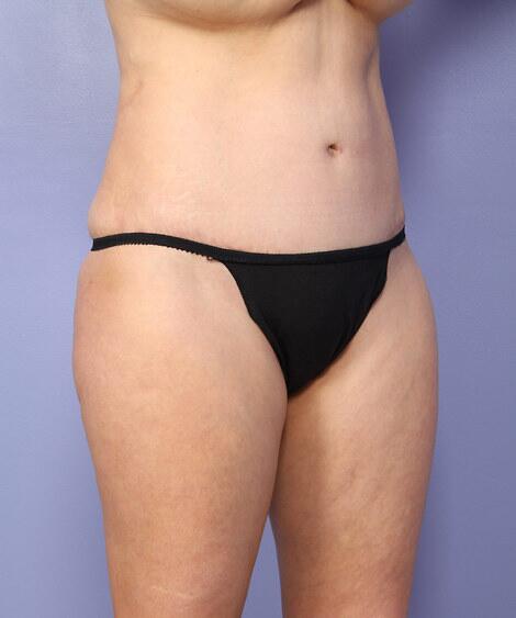 Liposuction Before & After Image