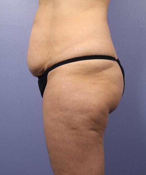 Liposuction Before & After Image