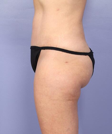 Liposuction Before & After Image