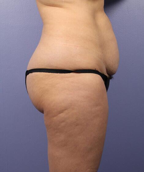 Liposuction Before & After Image