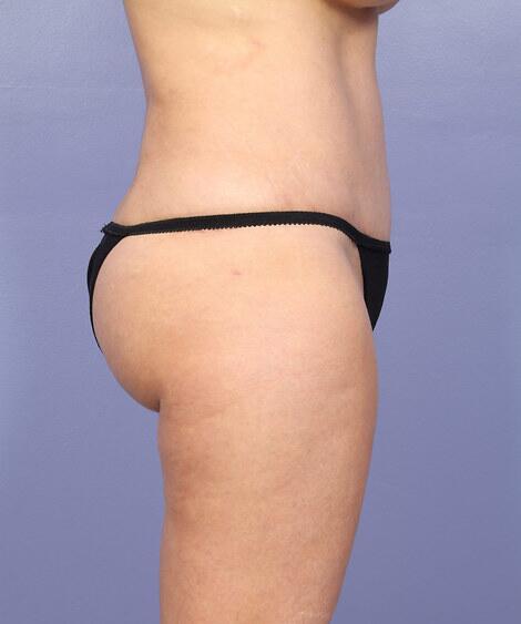 Liposuction Before & After Image