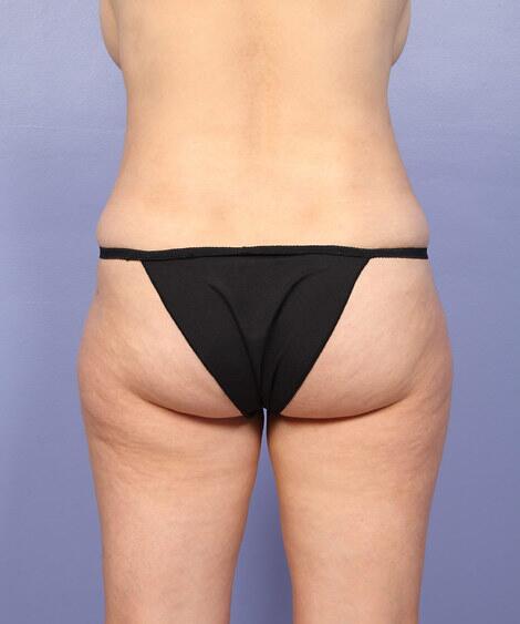 Liposuction Before & After Image