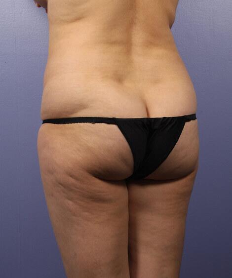 Liposuction Before & After Image