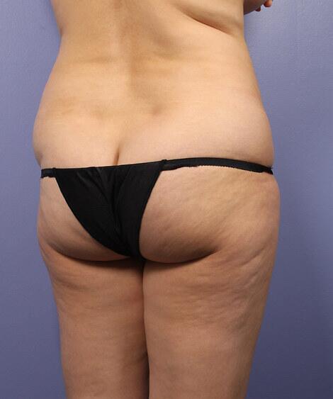 Liposuction Before & After Image