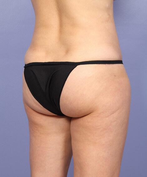 Liposuction Before & After Image