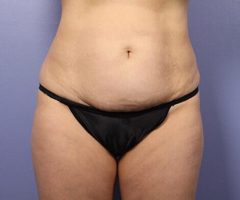 Liposuction Before & After Image