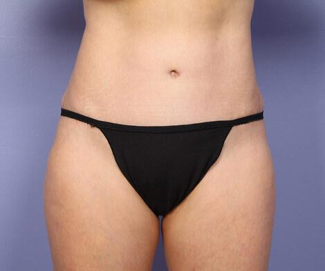 Liposuction Before & After Image