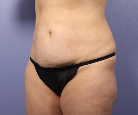 Liposuction Before & After Image