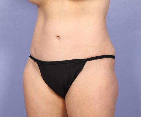 Liposuction Before & After Image