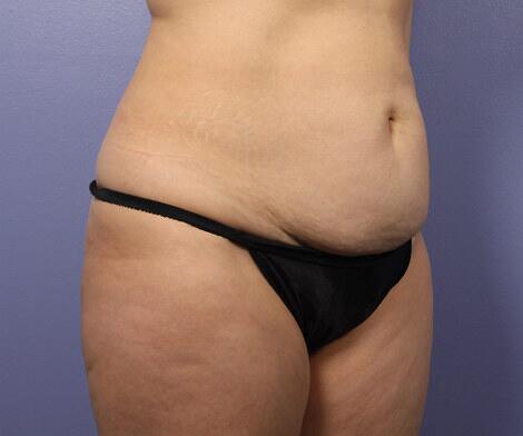 Liposuction Before & After Image