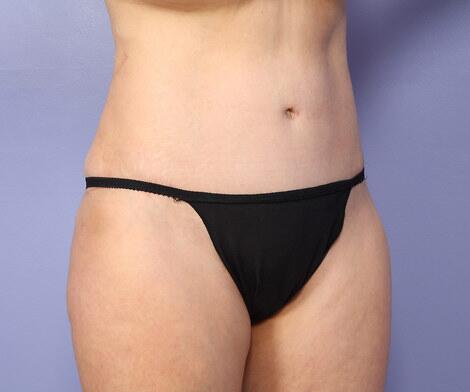 Liposuction Before & After Image