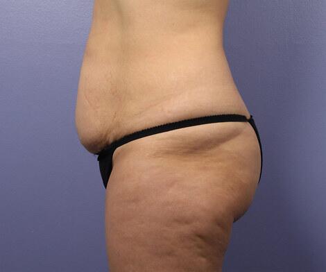 Liposuction Before & After Image