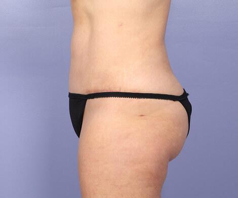 Liposuction Before & After Image