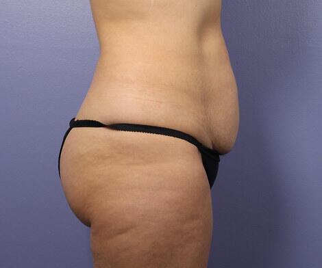 Liposuction Before & After Image