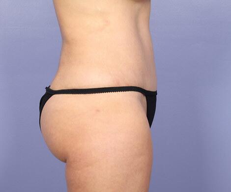 Liposuction Before & After Image