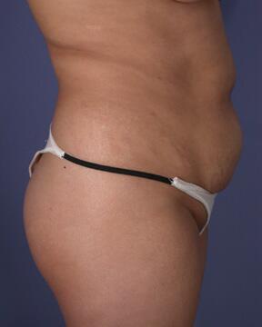 Liposuction Before & After Image