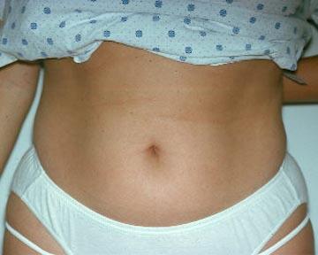 Liposuction Before & After Image