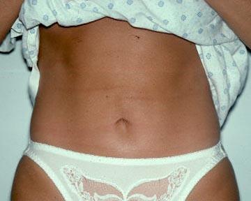 Liposuction Before & After Image