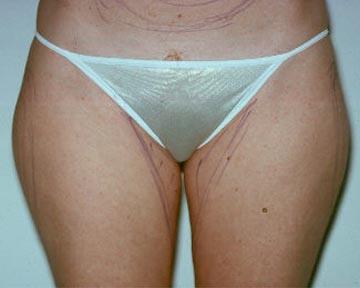 Liposuction Before & After Image