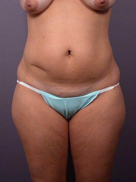 Liposuction Before & After Image