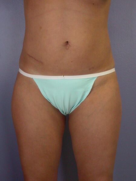 Liposuction Before & After Image