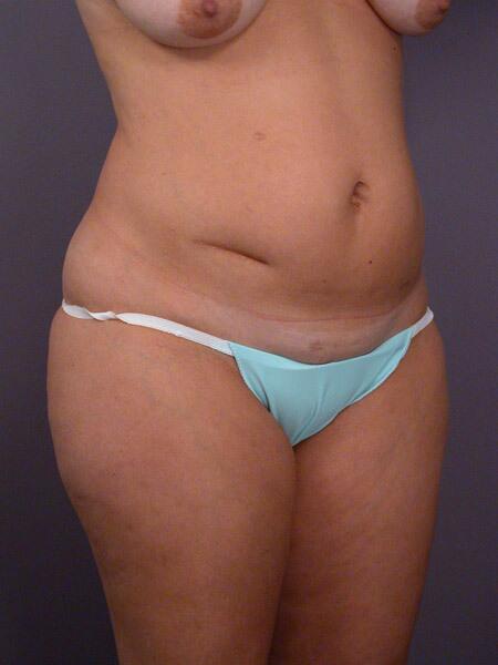 Liposuction Before & After Image