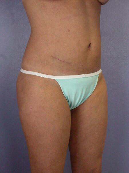 Liposuction Before & After Image