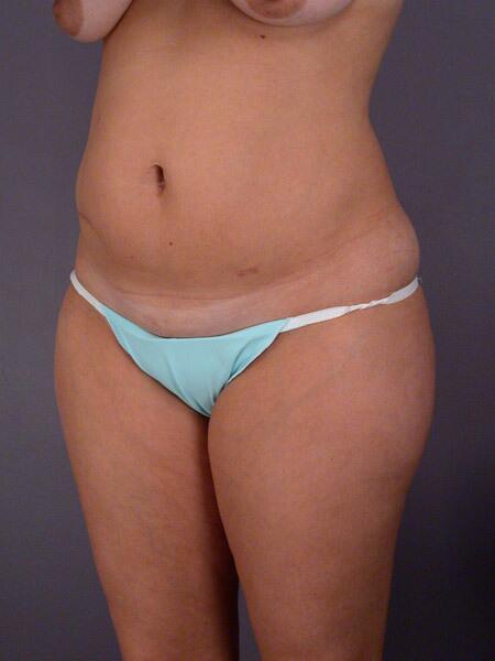 Liposuction Before & After Image