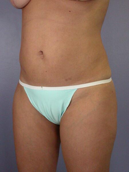 Liposuction Before & After Image