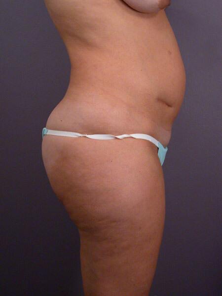 Liposuction Before & After Image