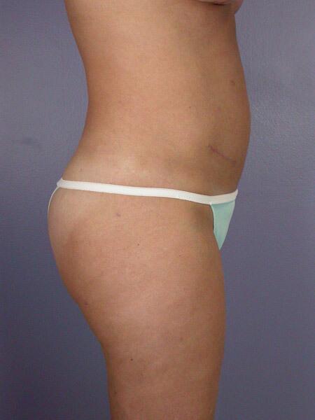 Liposuction Before & After Image