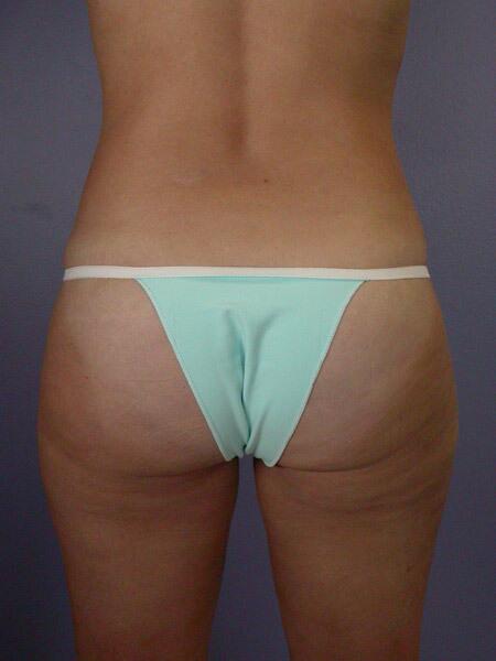 Liposuction Before & After Image