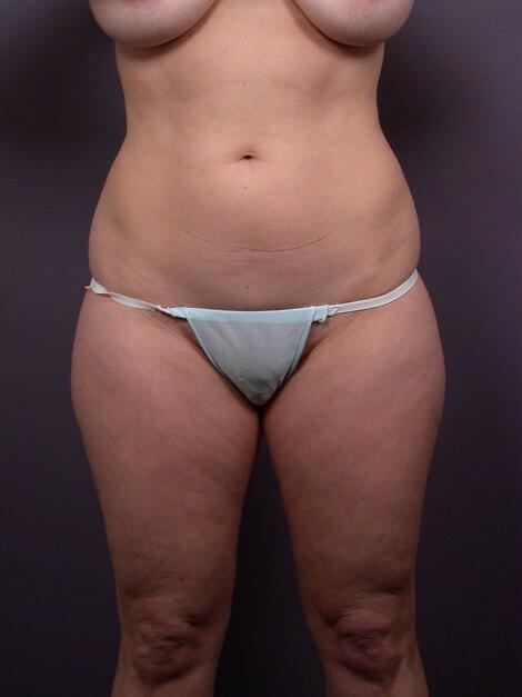 Liposuction Before & After Image