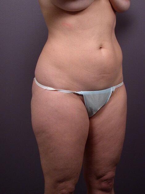 Liposuction Before & After Image