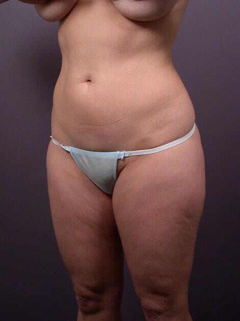 Liposuction Before & After Image