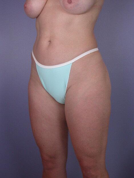 Liposuction Before & After Image