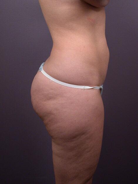 Liposuction Before & After Image