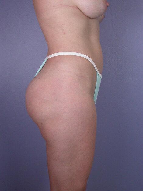 Liposuction Before & After Image