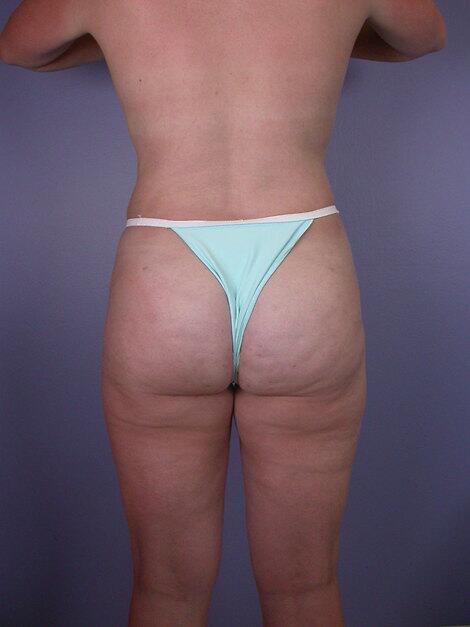 Liposuction Before & After Image