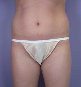 Liposuction Before & After Image