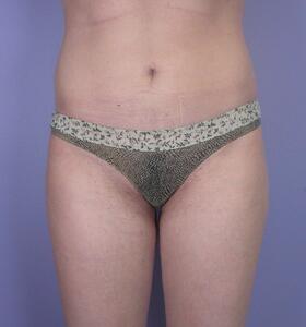 Liposuction Before & After Image