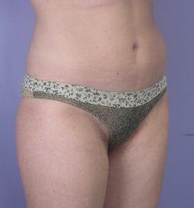 Liposuction Before & After Image