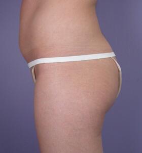 Liposuction Before & After Image