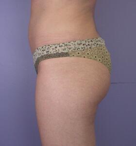 Liposuction Before & After Image