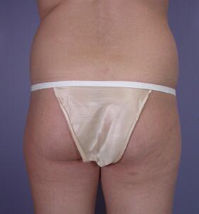 Liposuction Before & After Image