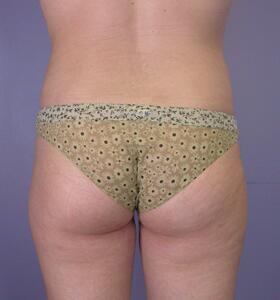 Liposuction Before & After Image