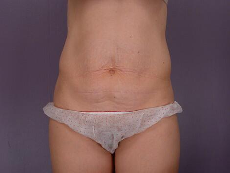 Liposuction Before & After Image