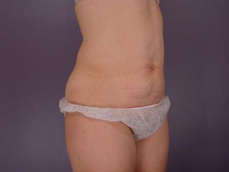 Liposuction Before & After Image