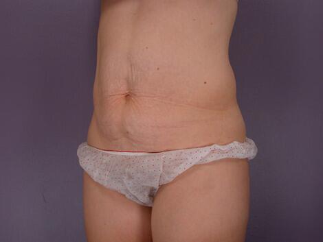 Liposuction Before & After Image